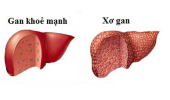 Xơ gan do rượu nguy hiểm thế nào?