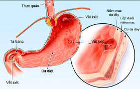 Người bị viêm loét dạ dày - tá tràng nên ăn gì?