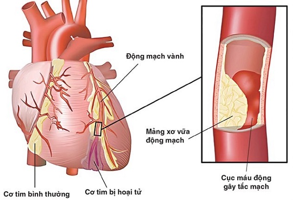 Nhồi máu cơ tim - Một biến chứng nguy hiểm