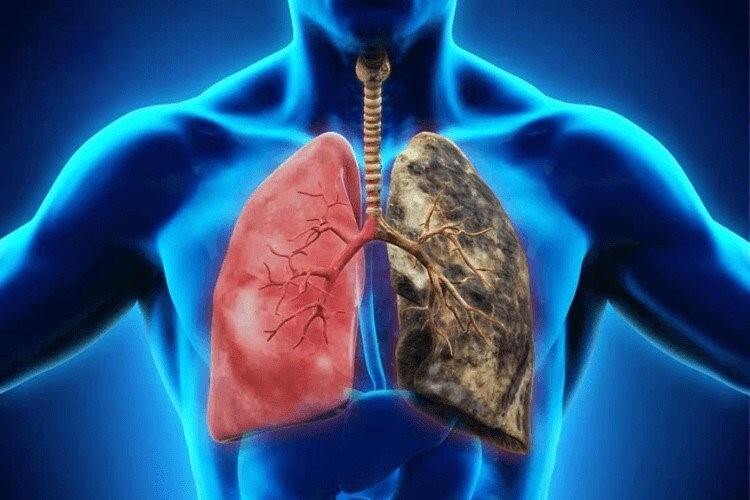 Phương pháp điều trị bệnh phổi tắc nghẽn mạn tính thời dịch