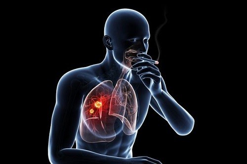 Ho cảnh báo nguyên nhân do ung thư phổi