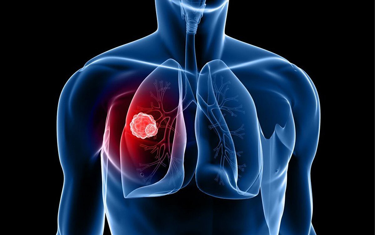 Thuốc trị ung thư phổi mới của Mỹ hoạt động thế nào