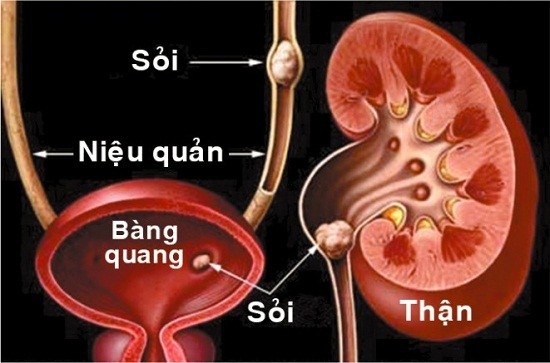 Sỏi tiết niệu, Nguyên nhân, biểu hiện, chuẩn đoán, cách điều