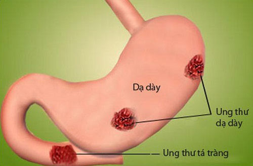 Ung thư dạ dày: "Án tử" cho những người chủ quan