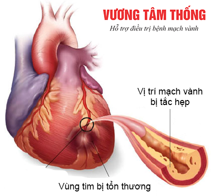 Bệnh Của Động Mạch Vành