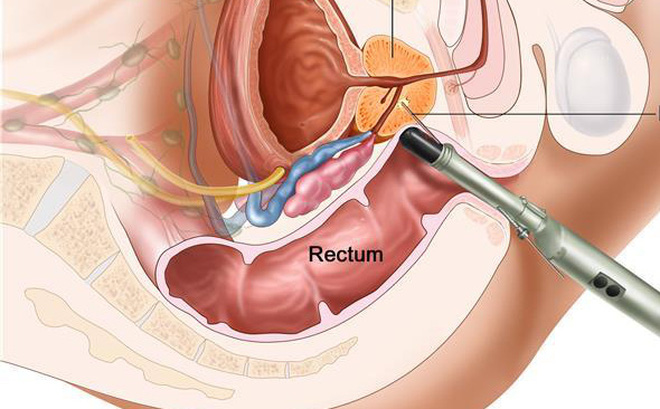 Căn bệnh ung thư mà cứ 7 đàn ông có 1 người mắc: 5 dấu hiệu cảnh báo rõ ràng nhất