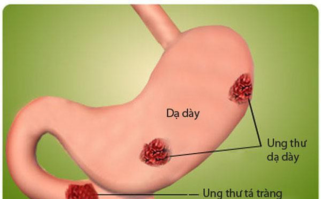 Cảnh báo 2 nguyên nhân khiến người Việt mắc ung thư dạ dày