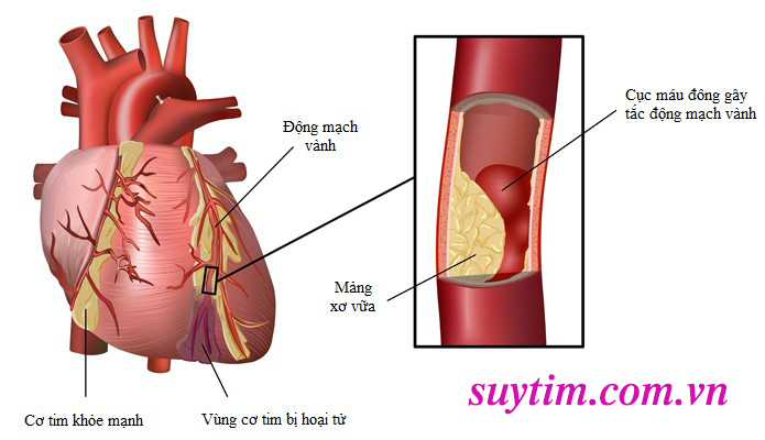 Chỉ định đặt stent mạch vành