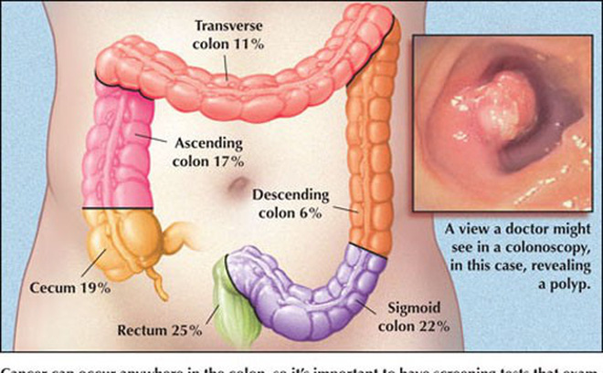 "chìa khóa vàng” để chữa ung thư đại trực tràng