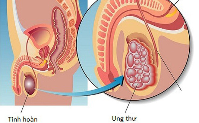 Ung thư tinh hoàn: biết sớm, chữa nhanh