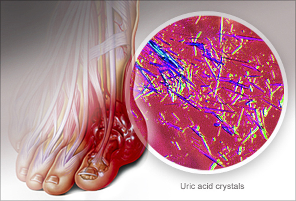 Bệnh gout và việc điều trị