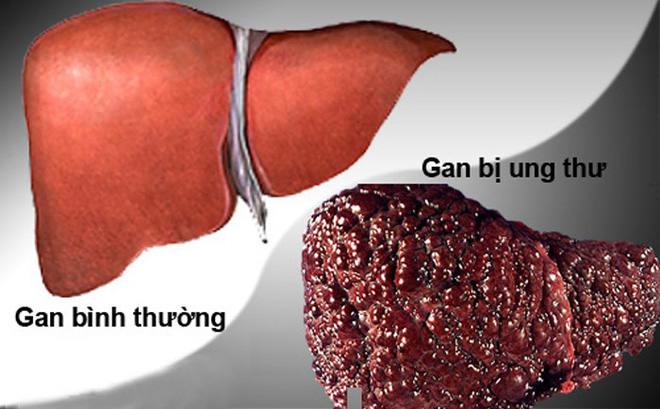 Dấu hiệu quan trọng cảnh báo bệnh gan đang tiến triển trong cơ thể, nếu có thì hãy đi khám