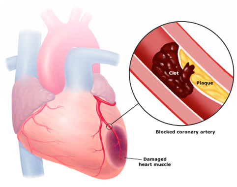 Đau tim, nhồi máu cơ tim và các dấu hiệu cảnh báo sớm