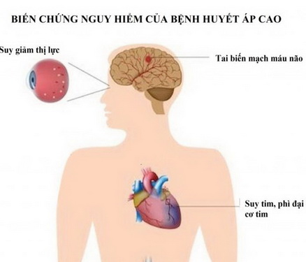 Lựa chọn thuốc tối ưu cho bệnh tăng huyết áp