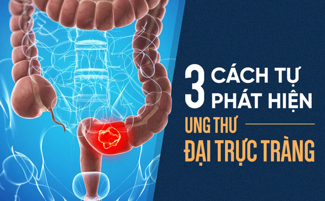 4 triệu người Việt mắc bệnh đại tràng