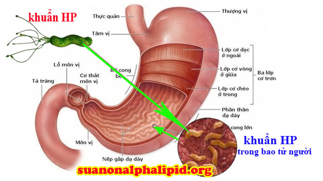 Cách chữa trị vi khuẩn H-Pylori Trong Dạ dày. (VOA)