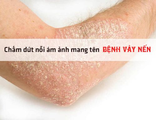 Tìm Hiểu Về Bệnh Vảy Nến - Bệnh vảy nến (VOA)