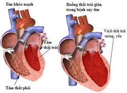 Triệu chứng bệnh nhồi máu cơ tim