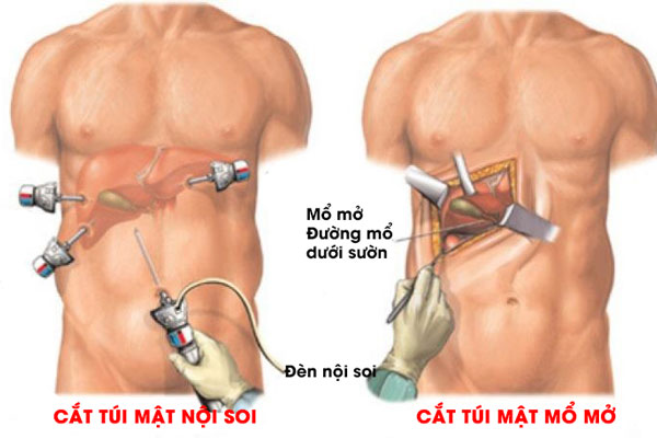 Cắt túi mật ảnh hưởng thế nào đến sức khỏe và hệ tiêu hóa của bạn?