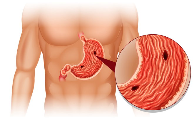 4 yếu tố nguy cơ gây ung thư dạ dày: Bạn cần khám sớm