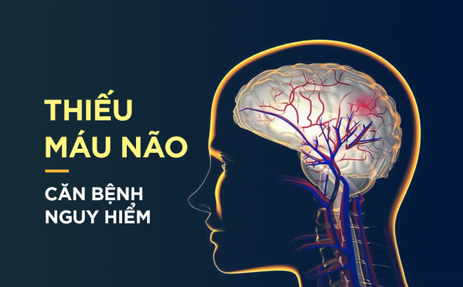 Thiếu máu não: Biểu hiện thoáng qua nhưng giết người trong “tích tắc”