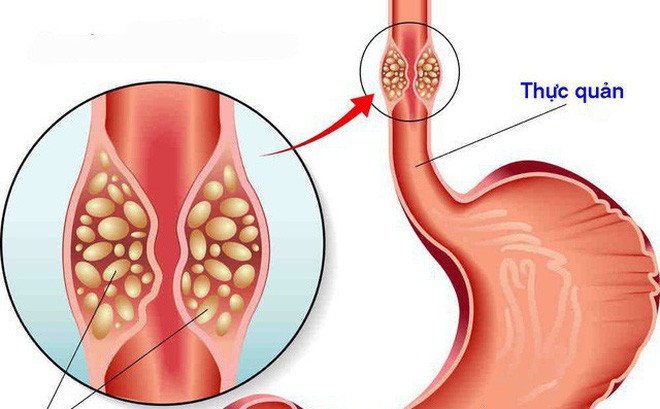 Ung thư thực quản - bệnh hay gặp ở người hút thuốc và uống rượu