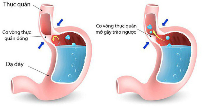 Nếu có 1 trong 4 dấu hiệu sớm nhất của bệnh ung thư dạ dày...