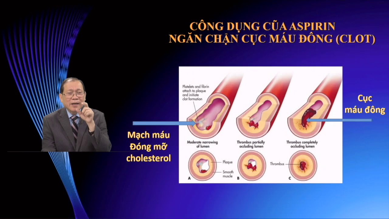 Video Tin Y Học - Tin Tức Mới Nhất Về Thuốc Aspirin