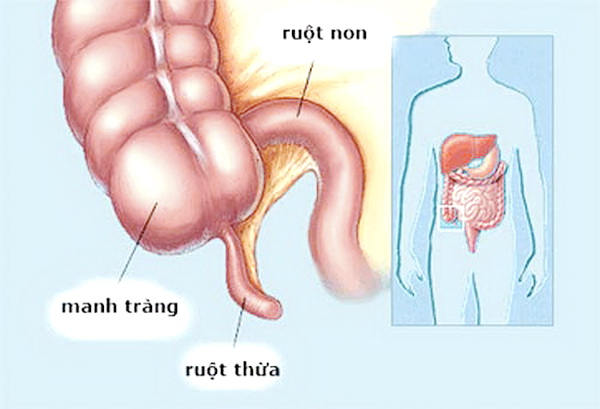 Dấu hiệu viêm ruột thừa?