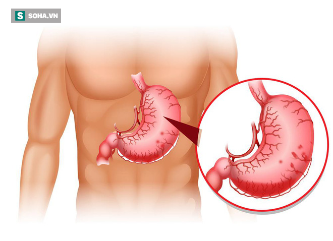 Tại sao bệnh dạ dày lại có thể tiến triển thành ung thư ?