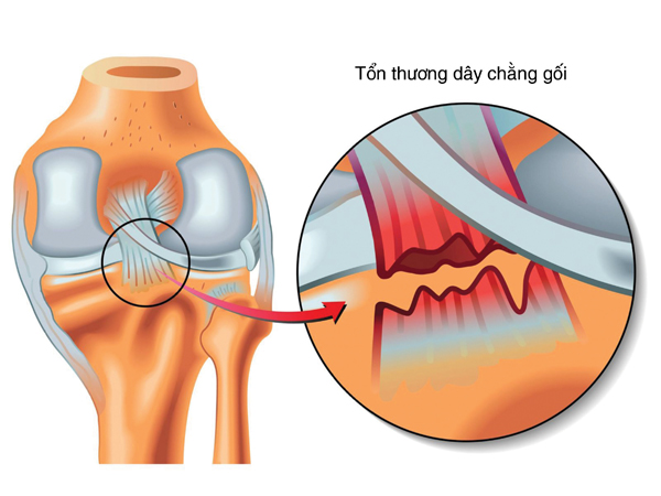 Đứt dây chằng chéo trước gối: Khi nào cần phẫu thuật?