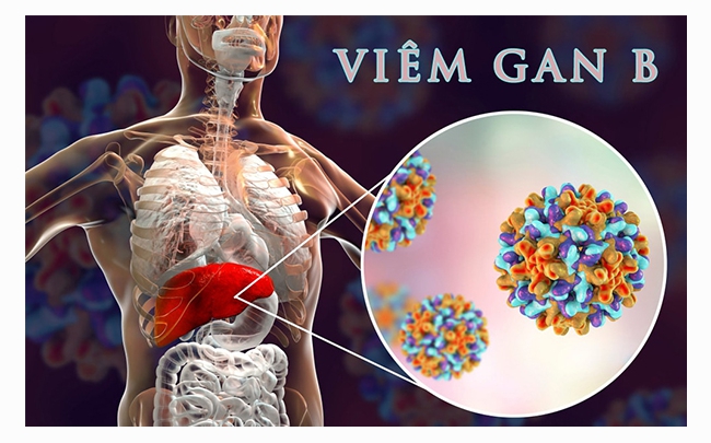 Tìm Hiểu Bệnh Viêm gan siêu vi B