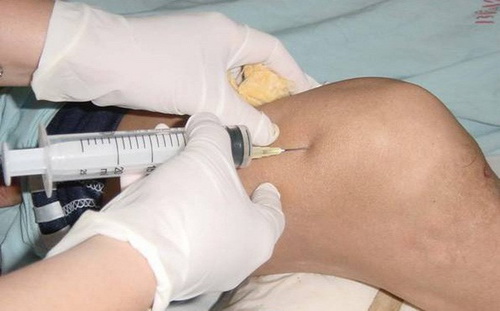 Lạm dụng tiêm khớp, biến chứng khó lường